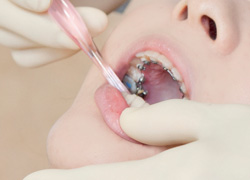 矯正中の虫歯予防